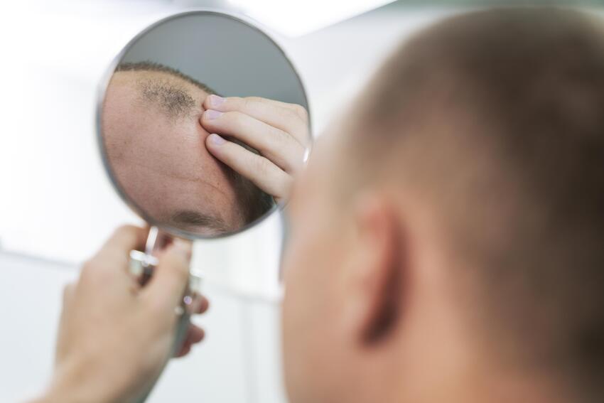 Man looking at the mirror and identifying the severity of his hair loss