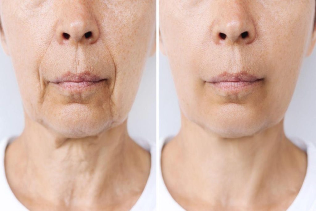 Lessen sagging skin through stem cell facial therapy