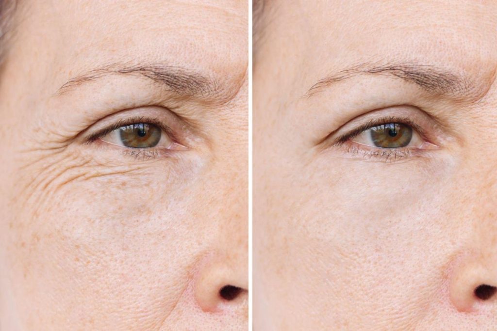 Removing wrinkles under the eyes